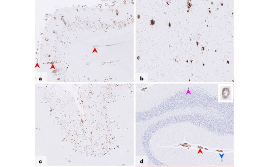 alzheimerraren-transmisio-bide-bat-deskribatu-dute